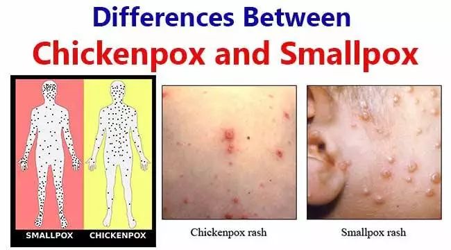 水痘和天花的皮疹分布和形态有所不同在水痘感染(水痘)患者中,病变