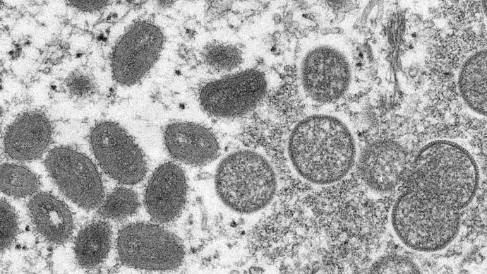 猴痘会成为下一场全球大流行病吗？有10个问题您应该知道