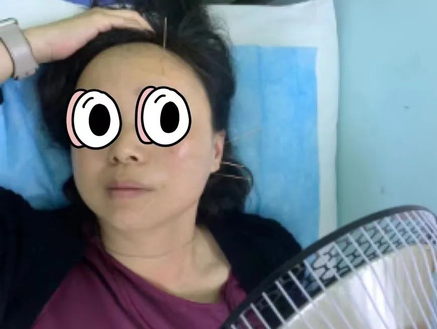 头发没吹干导致口眼歪斜带你认识贝尔面瘫