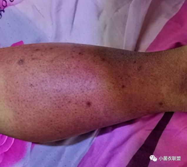 下肢红肿热痛小心惹毒上身