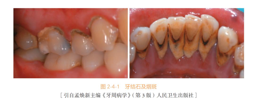 牙結石的危害原來這麼大