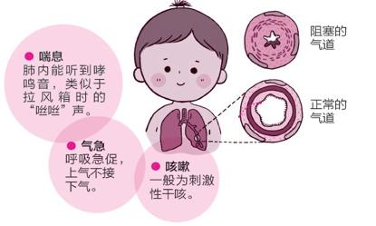 如果疏于治疗使哮喘反复发作,气道炎症会不断加重,最终可能发生不可逆