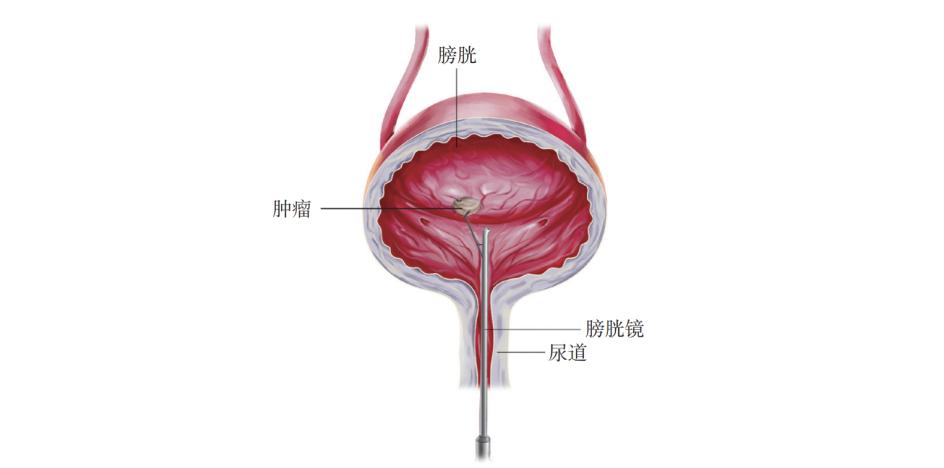 77健康知识"划重点"膀胱镜检查不仅是诊断膀胱癌的金标准,而且是