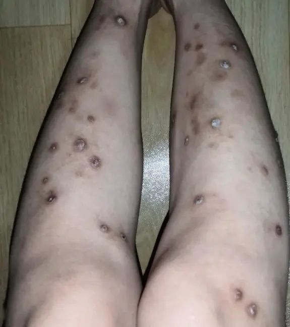 两条腿上都是剧痒的肉疙瘩我挠得指甲缝里都是血污