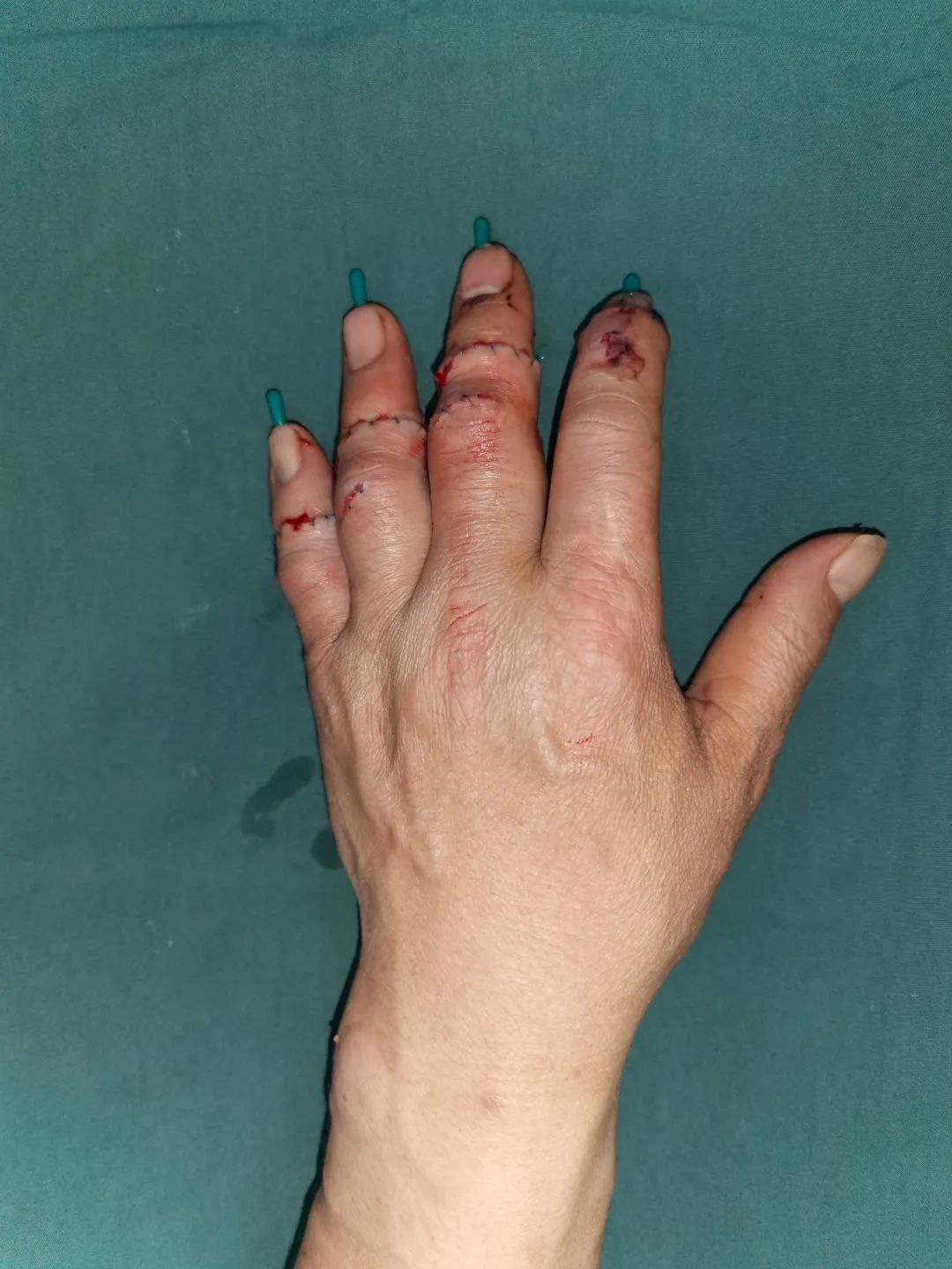 陈孝均副教授说:郭先生的左手手指治愈后,外观上与正常手指没有很大