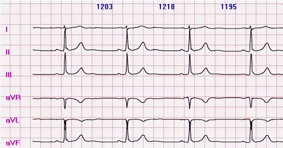1,窦性心动过速/缓窦性心律整齐,且没有心脏结构和血管的问题.