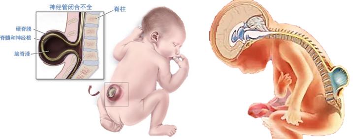 婴儿骶部凹陷图片图片