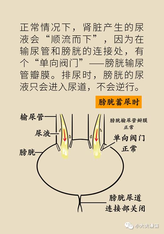 膀胱输尿管反流图片