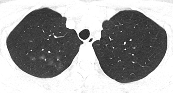 双肺多发磨玻璃结节这个病因你知道但想不到