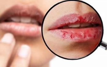嘴里发酸,口腔溃疡不断,嘴角溃烂是常事因为催吐使嘴和喉咙也会出现