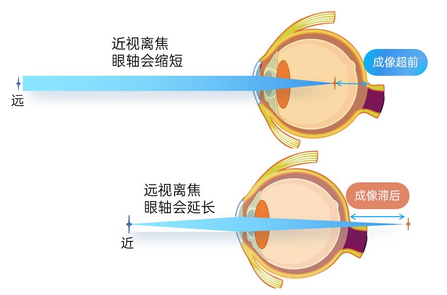 什么是雾视雾视屏和雾视镜真的能治疗近视吗