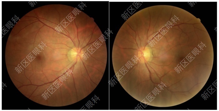 为什么要说焦度全国爱眼日｜从1例近视术后复视的治疗说开去_https://www.jmylbn.com_新闻资讯_第3张