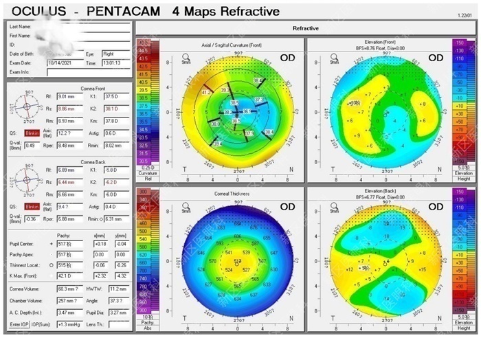 为什么要说焦度全国爱眼日｜从1例近视术后复视的治疗说开去_https://www.jmylbn.com_新闻资讯_第4张