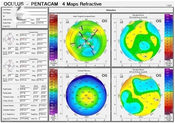 为什么要说焦度全国爱眼日｜从1例近视术后复视的治疗说开去_https://www.jmylbn.com_新闻资讯_第5张
