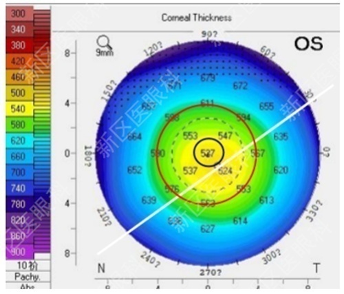 为什么要说焦度全国爱眼日｜从1例近视术后复视的治疗说开去_https://www.jmylbn.com_新闻资讯_第6张