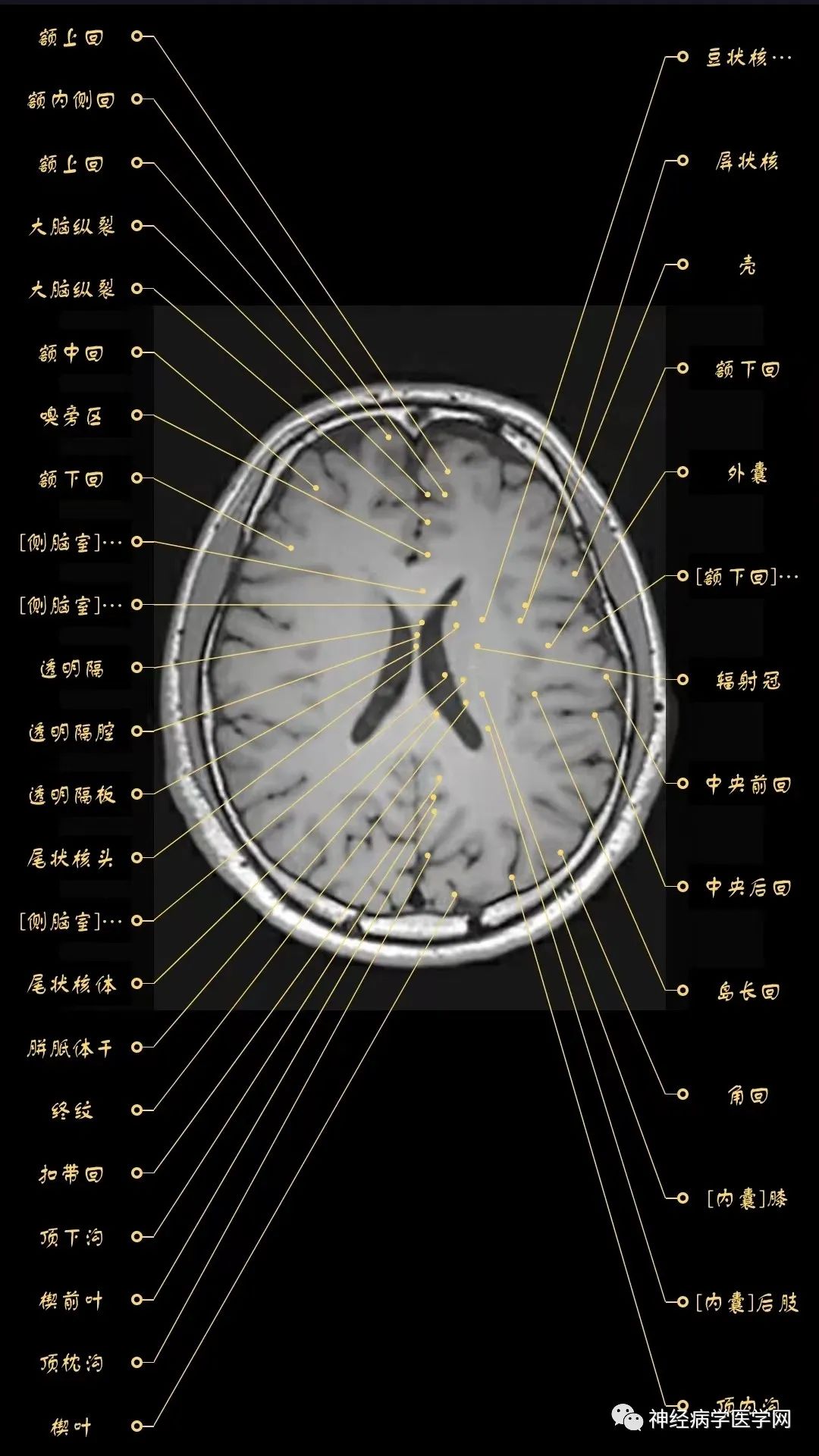 高清颅脑mri最全轴位影像解剖人手一册