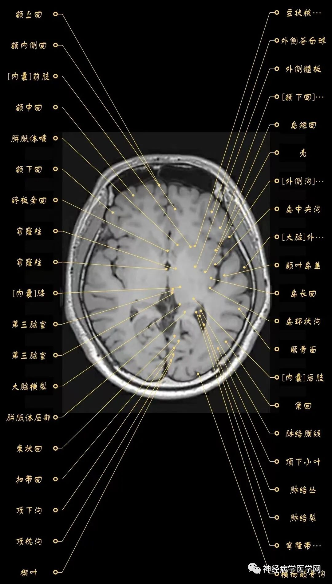 高清顱腦mri最全軸位影像解剖人手一冊