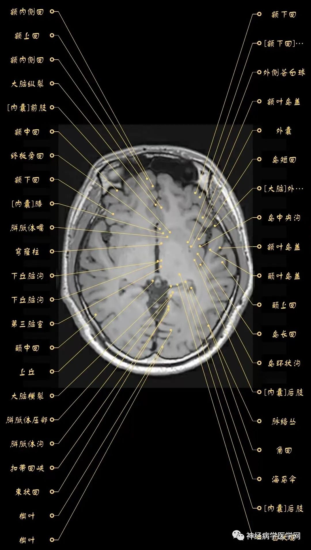 高清颅脑mri最全轴位影像解剖人手一册