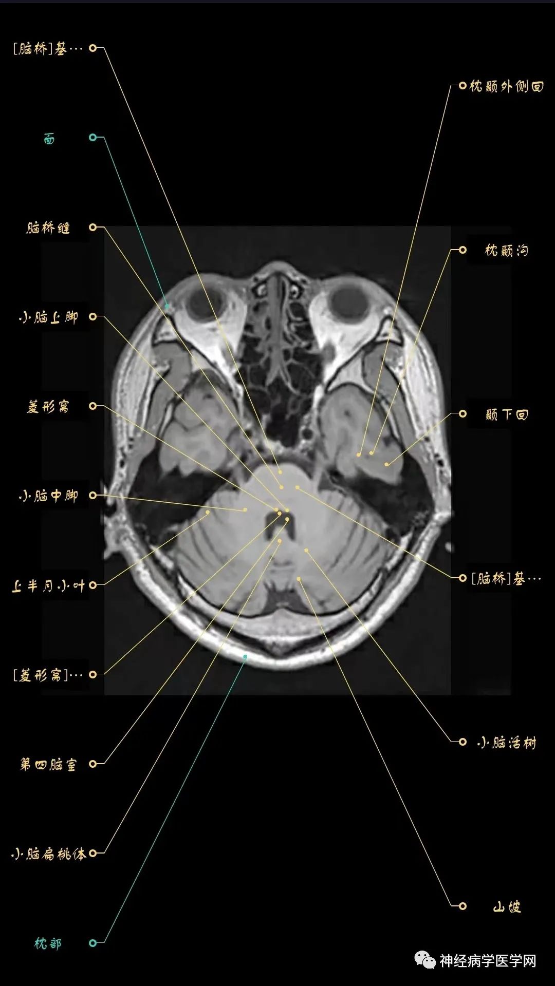 脑干mri断层解剖图图片