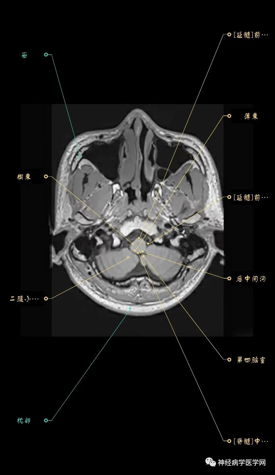 高清颅脑mri最全轴位影像解剖人手一册
