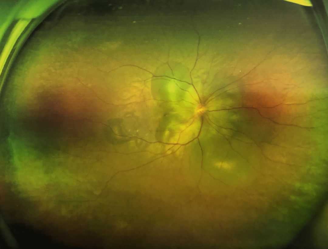 脉络膜的变性与营养不良性疾病——5、病理性近视的眼底改变 - 知乎