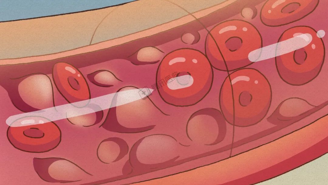 熬夜,奶茶,夜宵,会让你的血管发生什么?