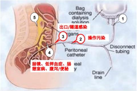 腹透出口感染图片图片