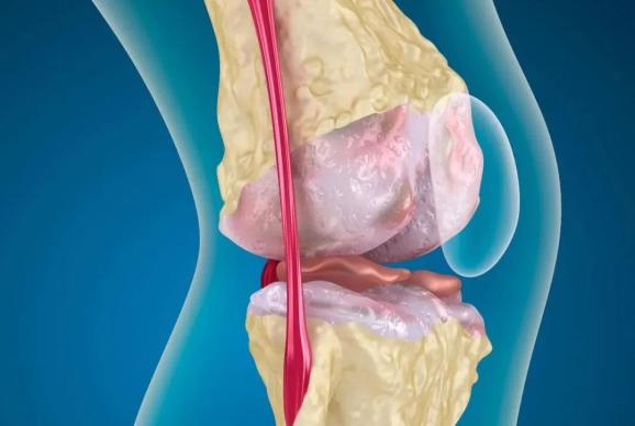 骨质疏松多久能见效果 841.jpg