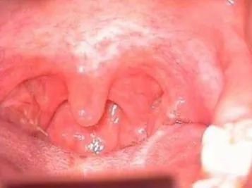 成人喉镜型号怎么选择协和医生说｜鱼刺卡嗓子眼了，你还在吃饭团、喝醋吗？_https://www.jmylbn.com_新闻资讯_第4张