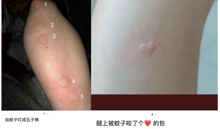 千万别挠蚊子包,我们建议你:掐十字