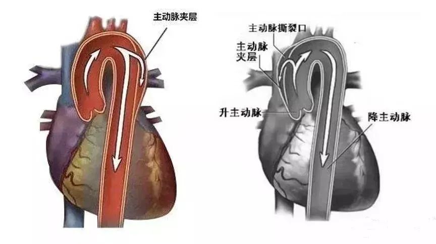 院区心外科孙文宇教授团队y型人工血管转流技术护航主动脉夹层患者