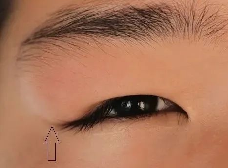 父母必知孩子眉毛附近摸着有硬块或是皮样囊肿