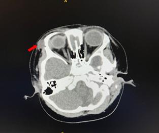 父母必知孩子眉毛附近摸着有硬块或是皮样囊肿