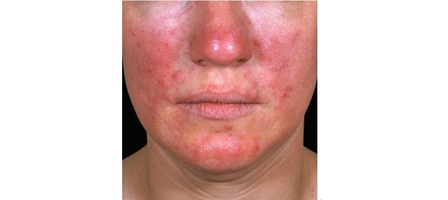 过敏痘痘发炎口罩戴久惹上口罩脸