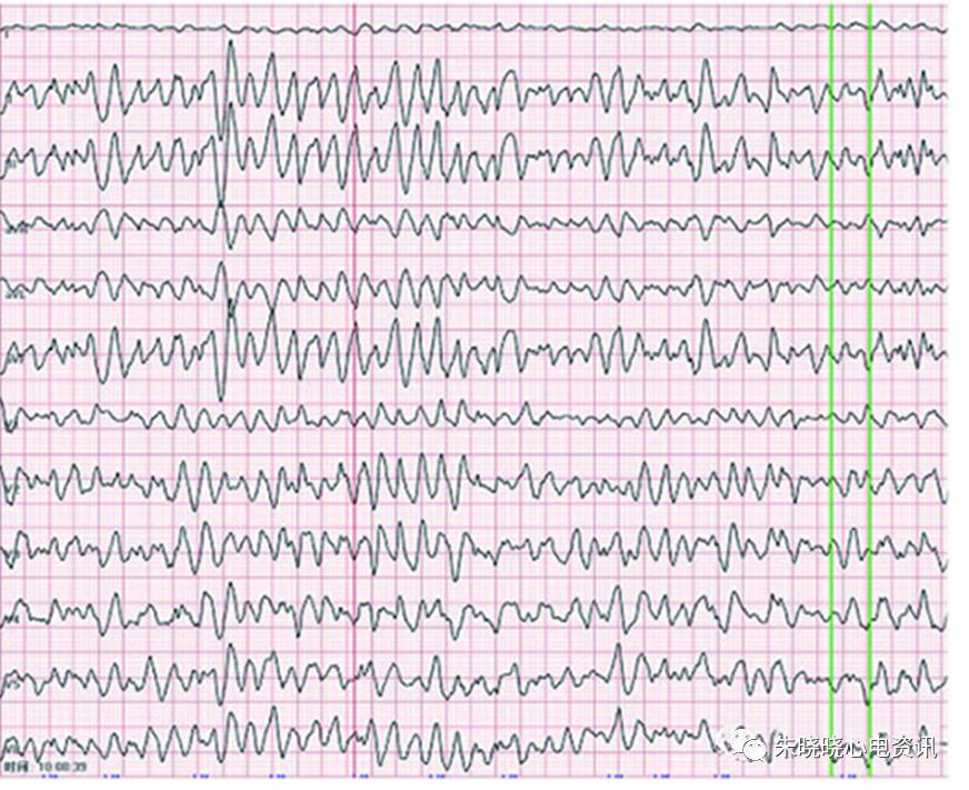 心室颤动心电图表现图片