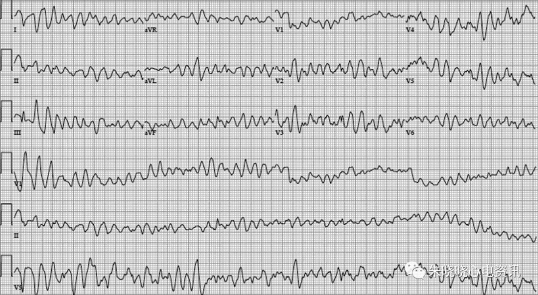 心室颤动心电图表现图片