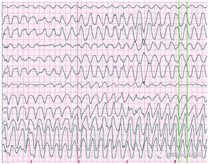 (2)心电图表现:心室扑动呈正弦波图型,波幅大而规则,频率150~300次