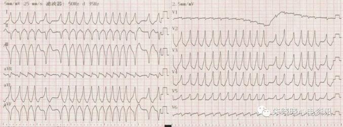 假如心房顫動的心室率已很快,靜脈注射維拉帕米甚至會誘發心室顫動心