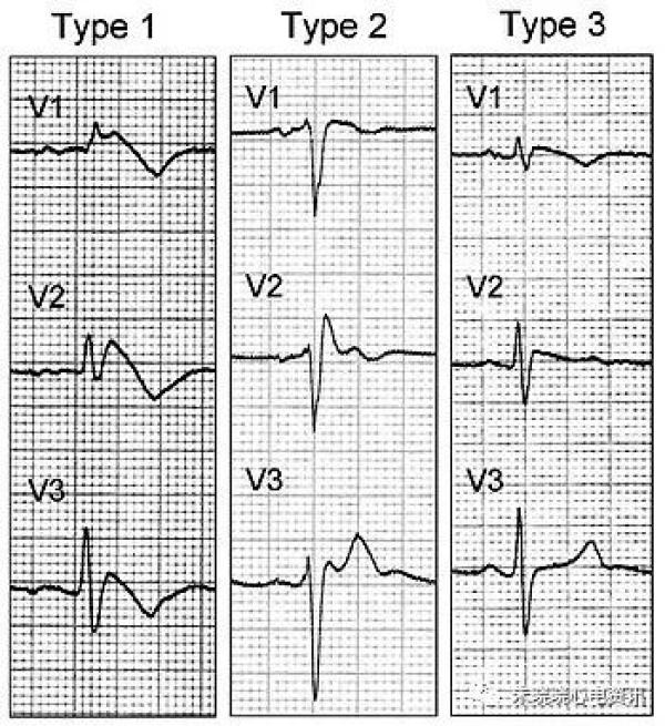 教你识别几种致命疾病的心电图
