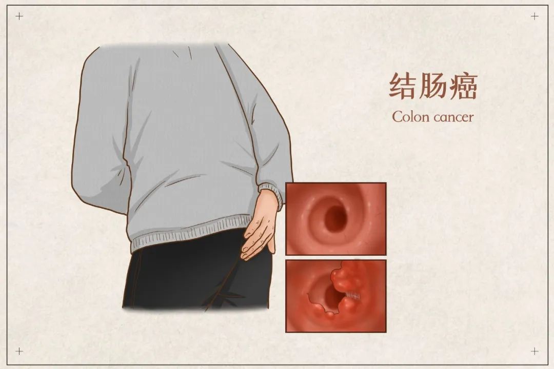 结核性腹膜炎腹部照片图片