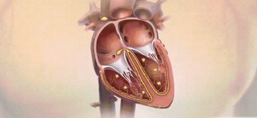 更常见的是第二种心脏躁动(心室颤动),不该放电的地方胡乱放电,类似于