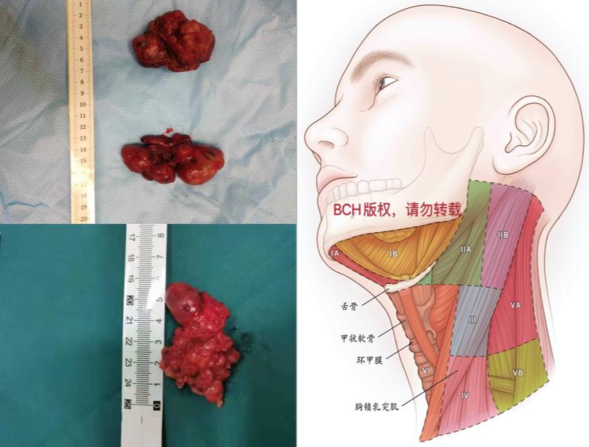 甲狀腺結節十問十答