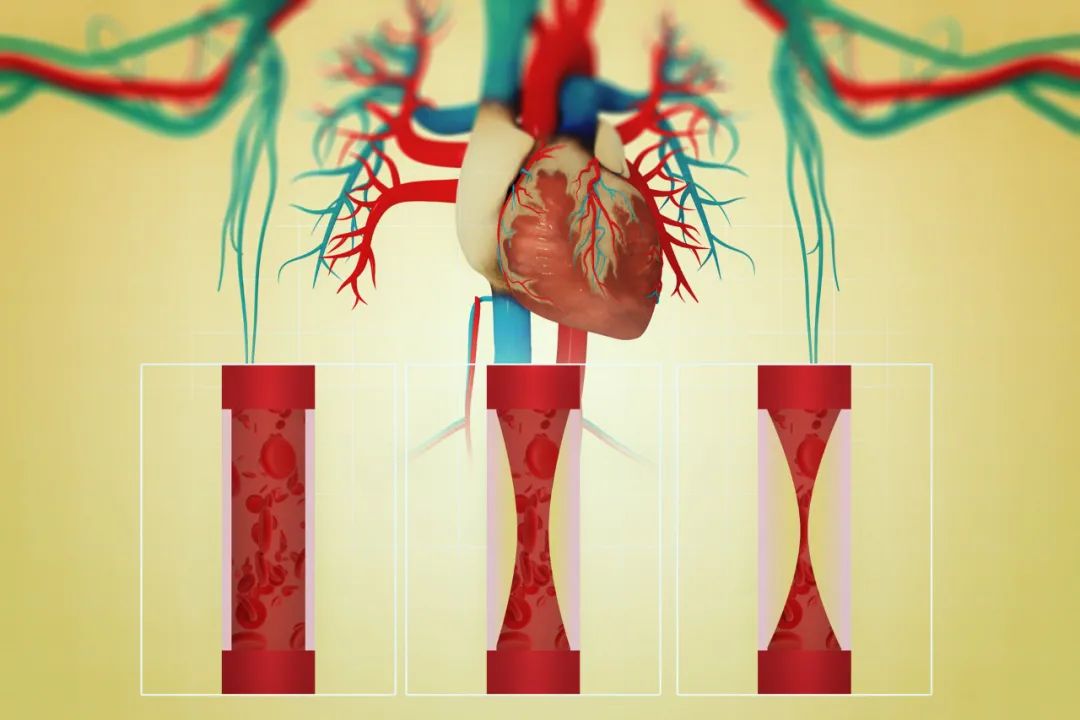 什么是外周支架冠脉支架搭了以后不能运动也不能做核磁？这4大误区一定要纠正_https://www.jmylbn.com_新闻资讯_第4张