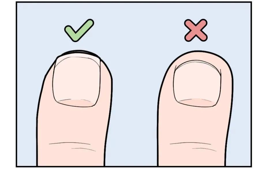 指甲总往肉里长结果我得了这种病