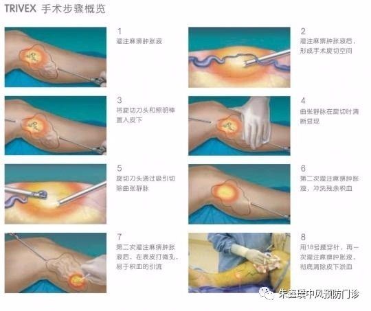 血管闭合系统是什么“下肢静脉曲张”的最佳治疗_https://www.jmylbn.com_新闻资讯_第4张