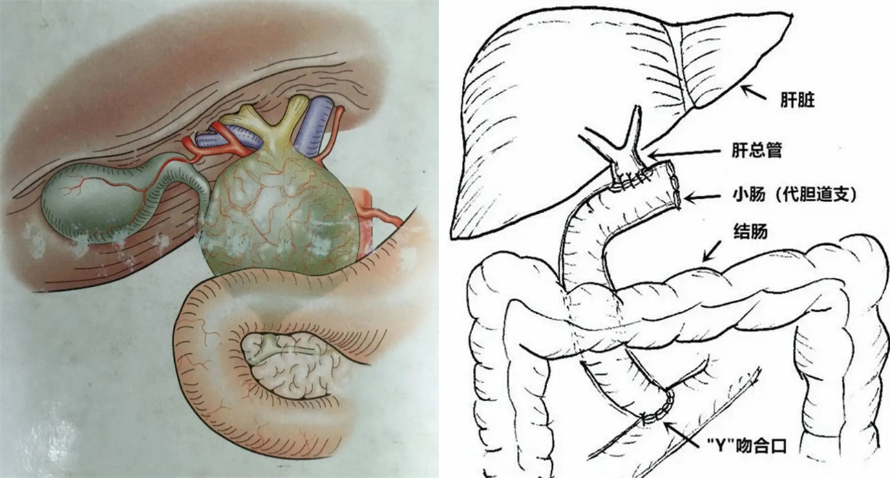 看过来今天说先天性胆总管囊肿