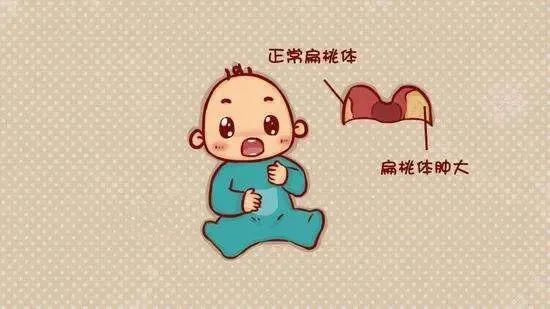 扁桃体和腺样体肥大是儿童鼾症最常见的病.