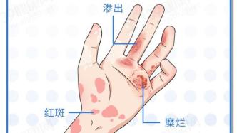 皮肤最怕的8种小红点，摸一摸就可能传染