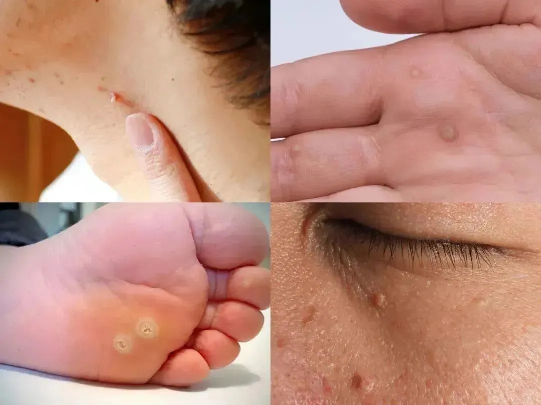 皮肤上这种小凸起其实是hpv感染太容易被忽略