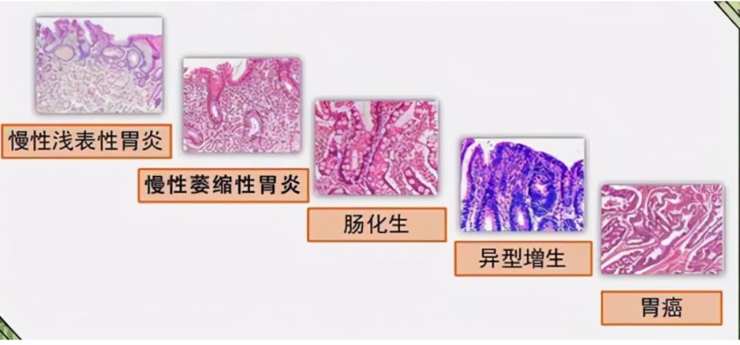 首先需祛除病因,根除幽門螺桿菌,可部分逆轉胃黏膜萎縮,阻滯胃癌進程